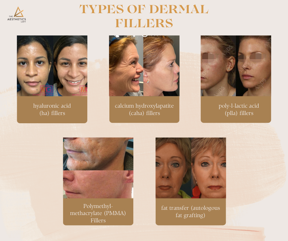 Types of Dermal Fillers