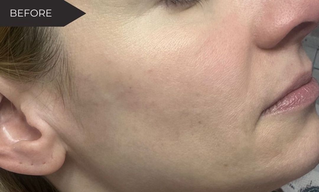 Skin Health Treatments in Milford, CT​ Before After Images 1