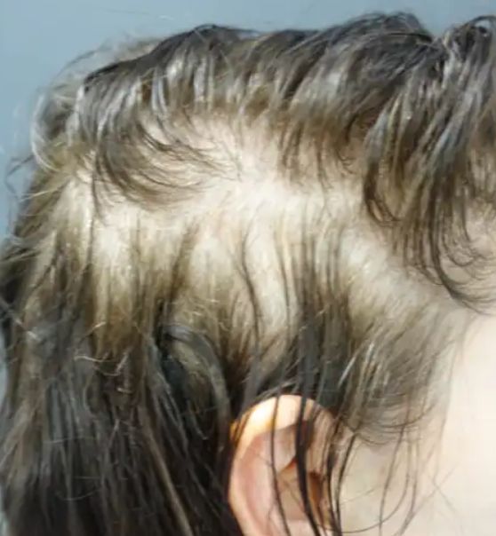 Microneedling for Hair Restoration before after images 10