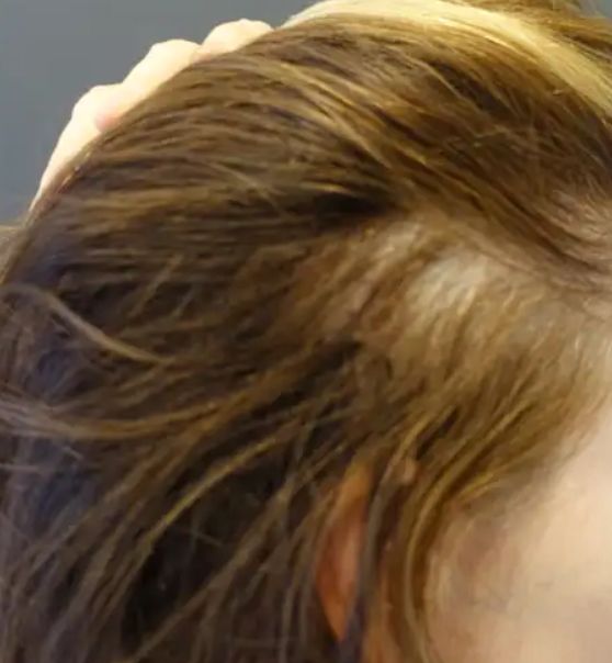 Microneedling for Hair Restoration before after images 11
