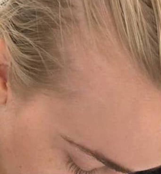 Microneedling for Hair Restoration before after images 12