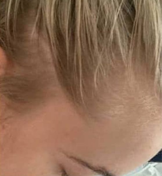 Microneedling for Hair Restoration before after images 13