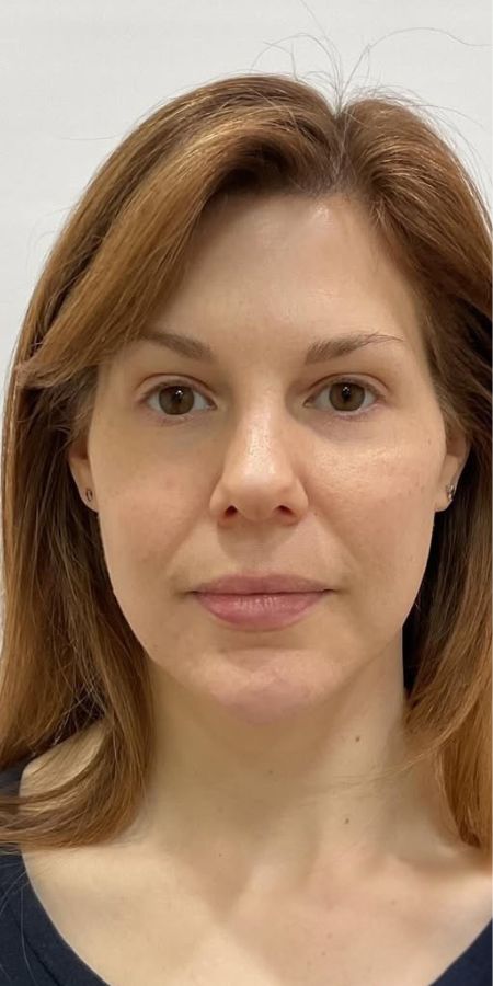 Dermal Filler in Milford, CT Before after images 2