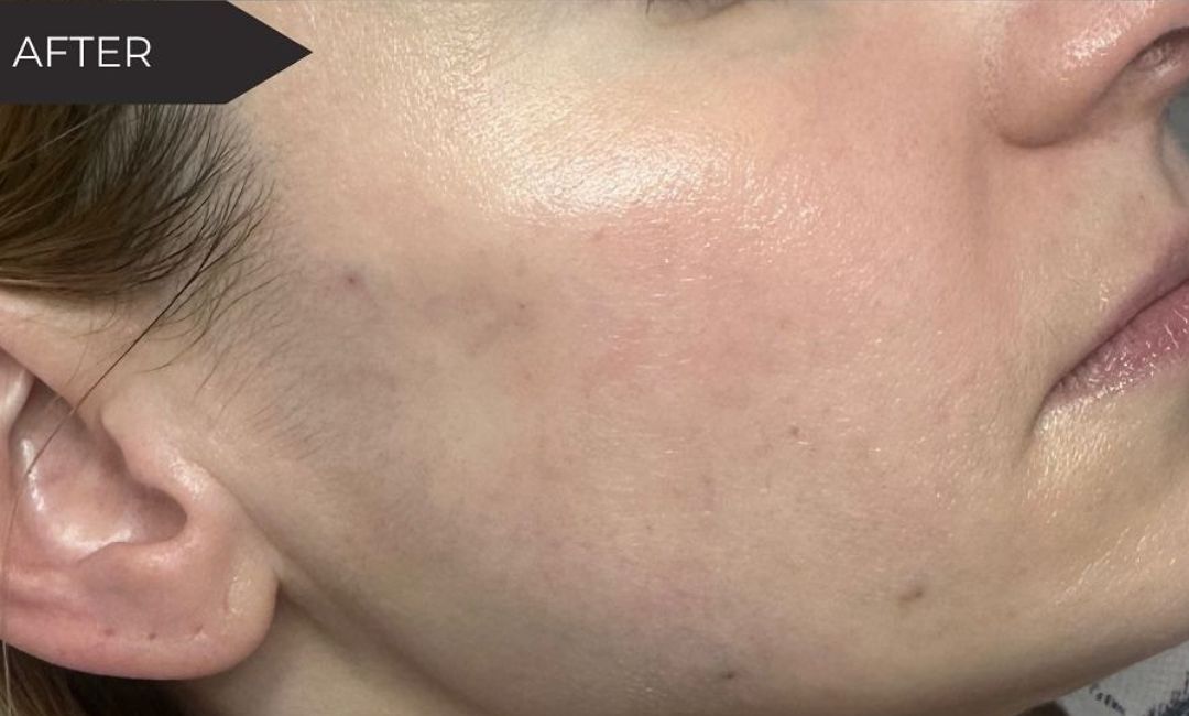 Skin Health Treatments in Milford, CT​ Before After Images 2
