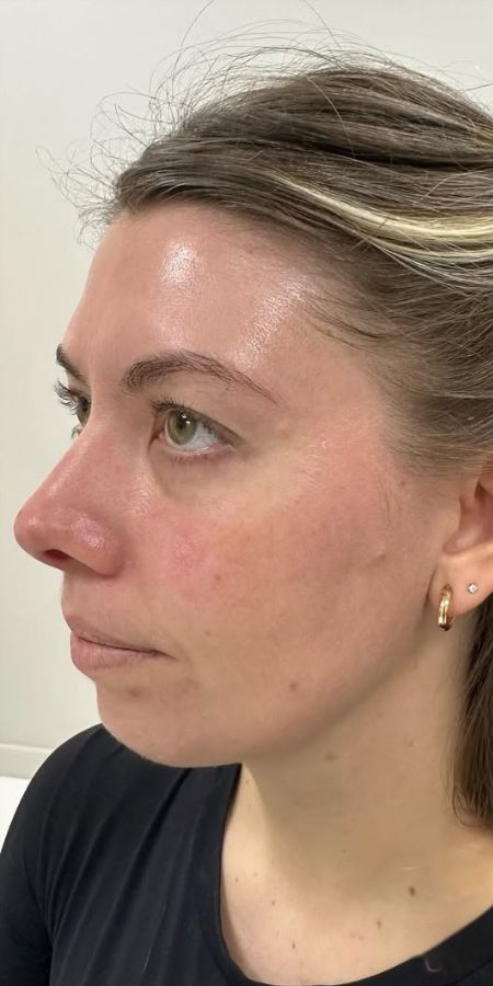Dermal Filler in Milford, CT Before after images 3