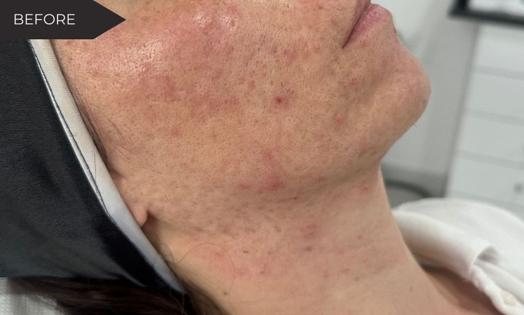 Skin Health Treatments in Milford, CT​ Before After Images 3
