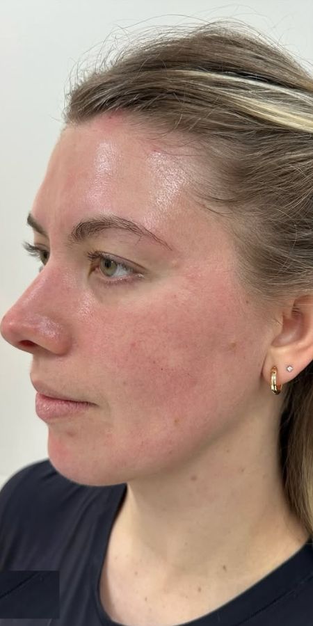 Dermal Filler in Milford, CT Before after images 4