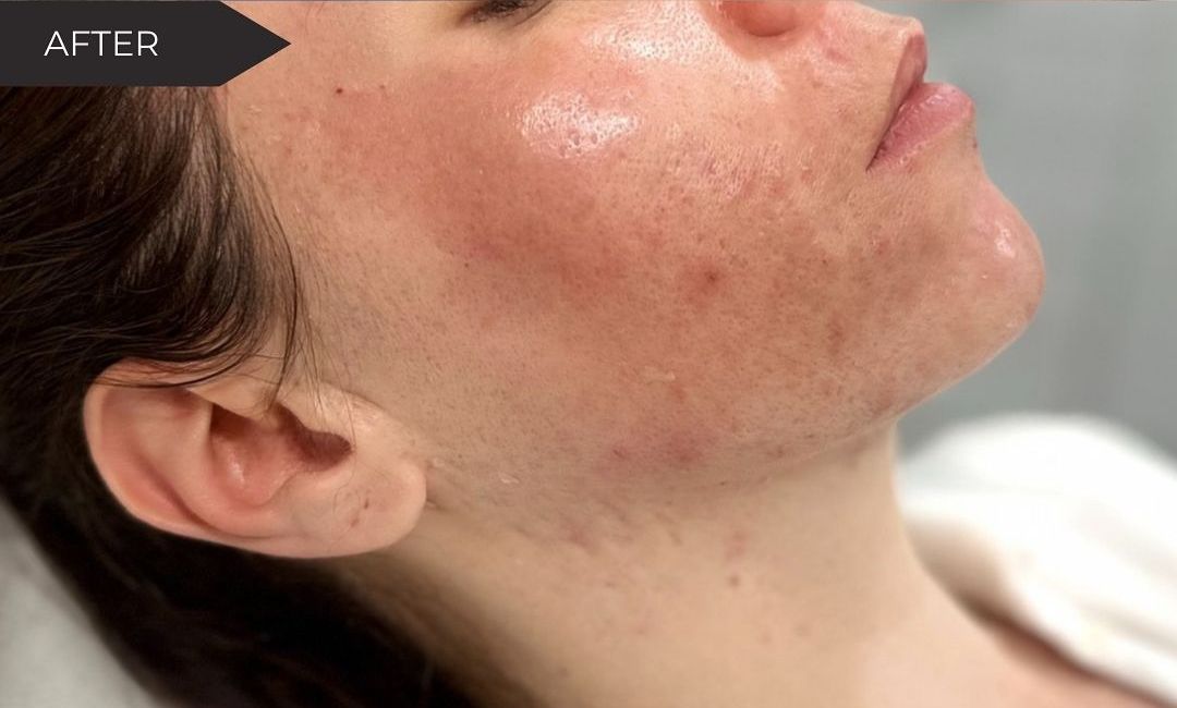 Skin Health Treatments in Milford, CT​ Before After Images 4