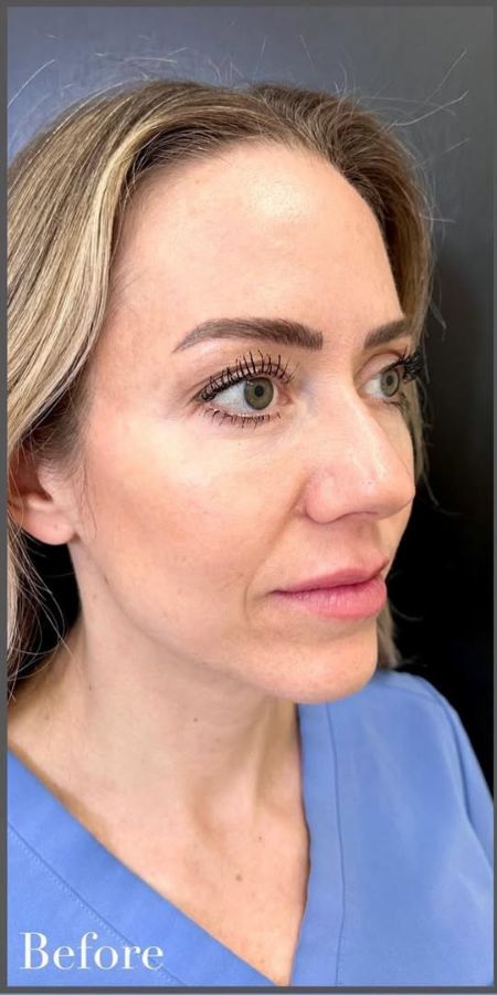 Dermal Filler in Milford, CT Before after images 5