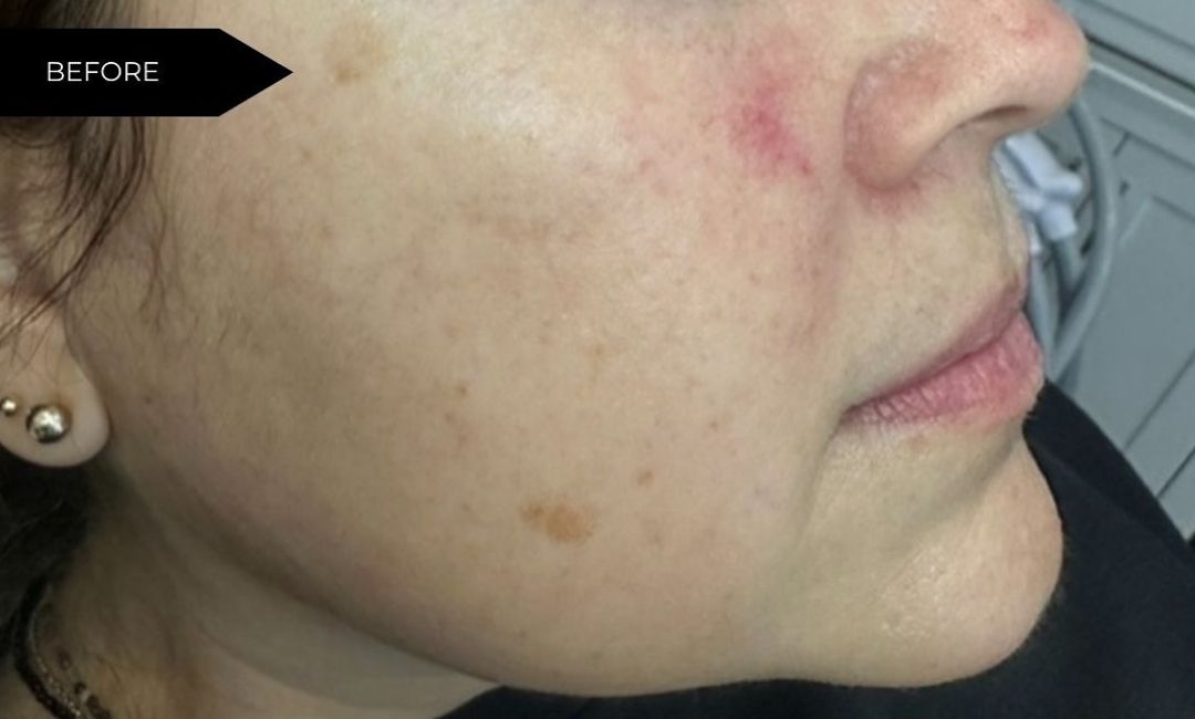 Skin Health Treatments in Milford, CT​ Before After Images 5