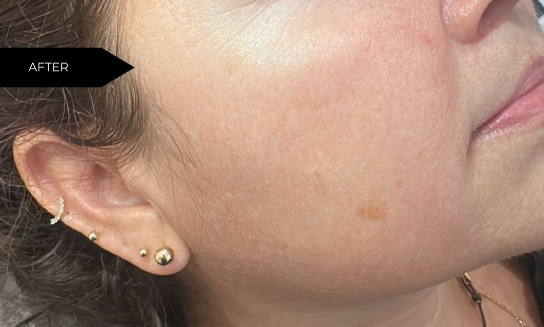 Skin Health Treatments in Milford, CT​ Before After Images 6