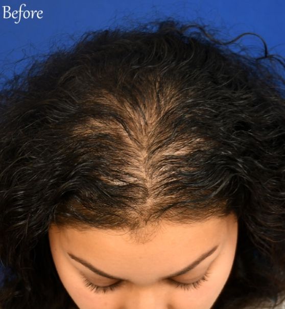 Microneedling for Hair Restoration before after images 8