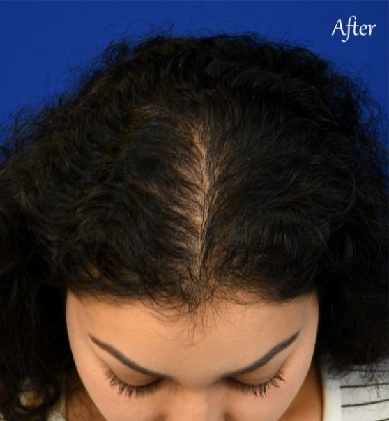 Microneedling for Hair Restoration before after images 9