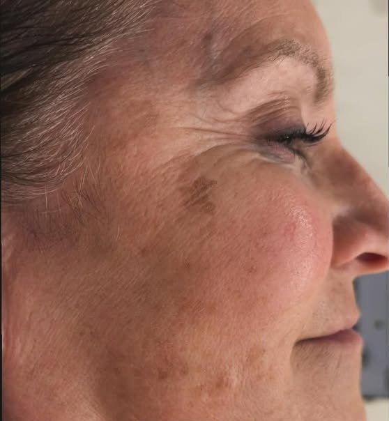 The-Aesthetics-Loft laser-treatments-in-milfordore-and-after images