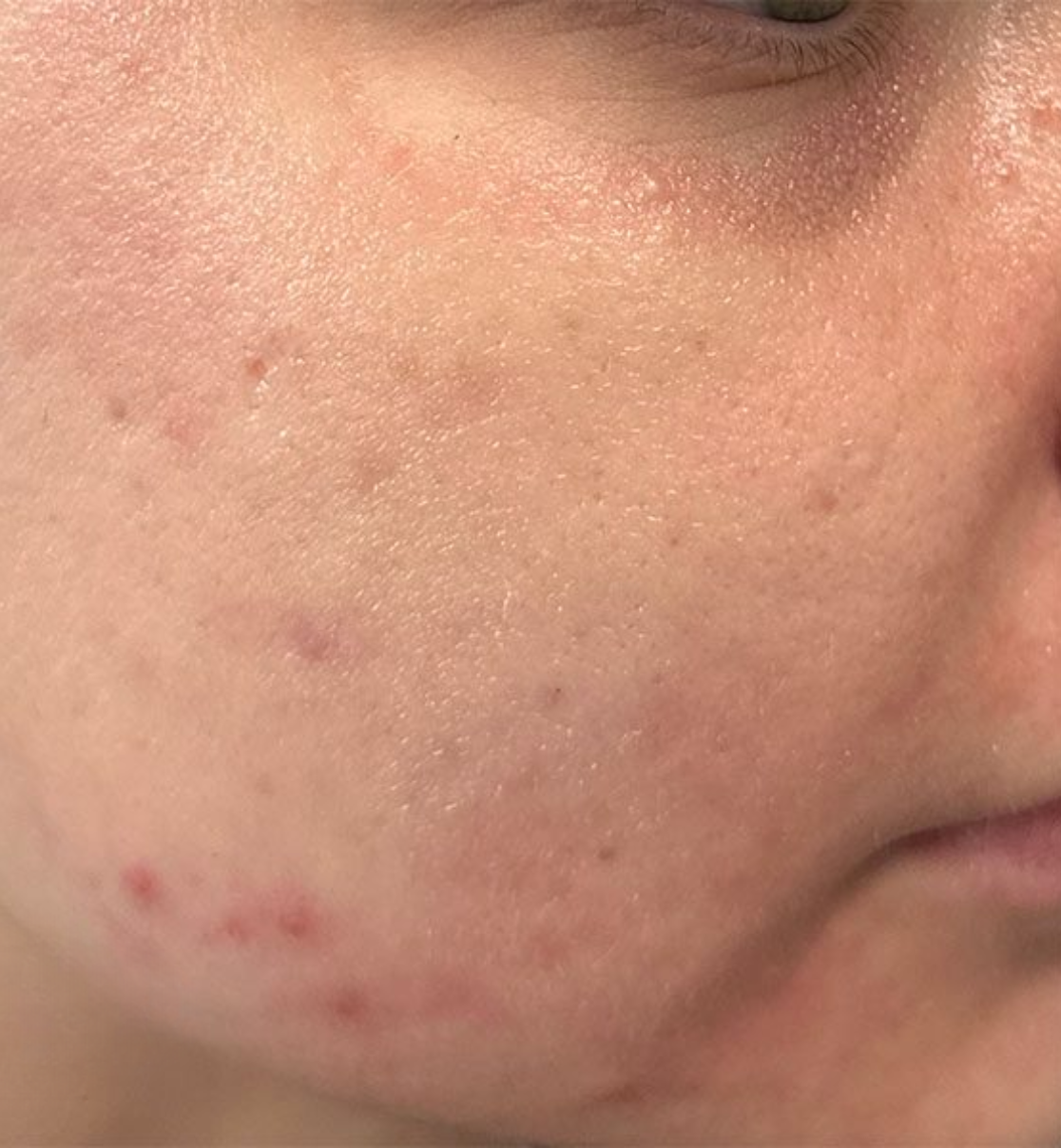 The-Aesthetics-Loft laser-treatments-in-milfordore-and-after images