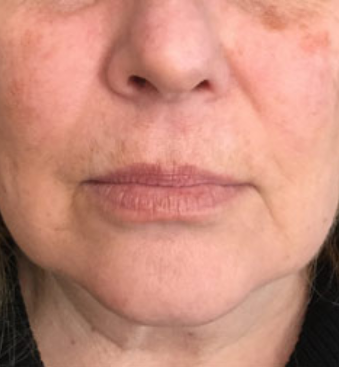 The-Aesthetics-Loft laser-treatments-in-milfordore-and-after images