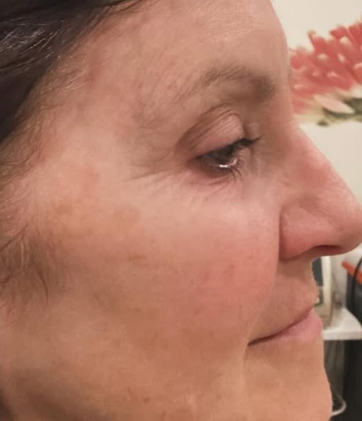 The-Aesthetics-Loft laser-treatments-in-milfordore-and-after images