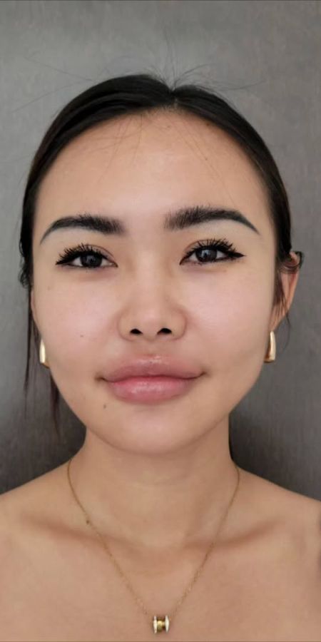 11 Dermal Filler in Milford, CT Before after images