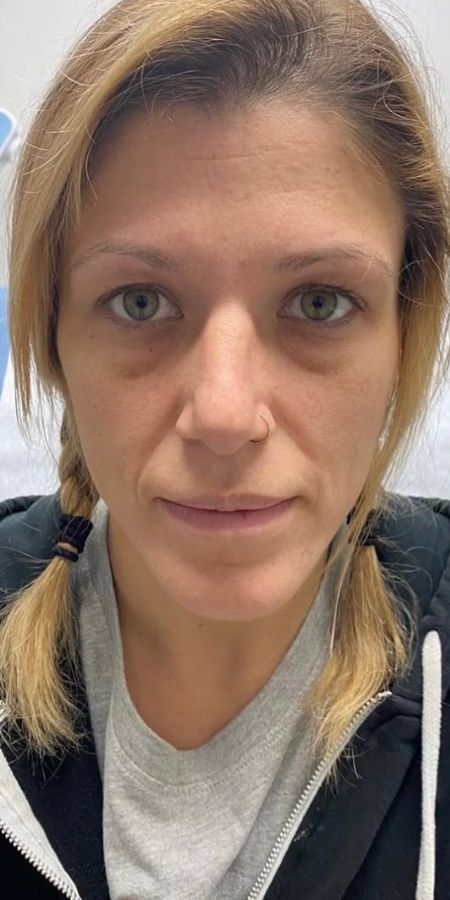 neurotoxins in Milford, CT Before after images