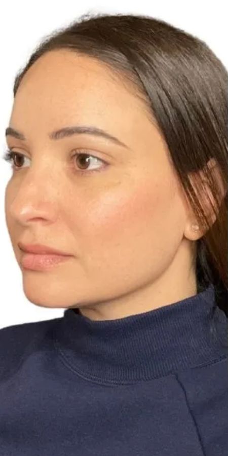7 Dermal Filler in Milford, CT Before after images