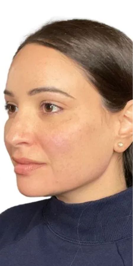 8 Dermal Filler in Milford, CT Before after images