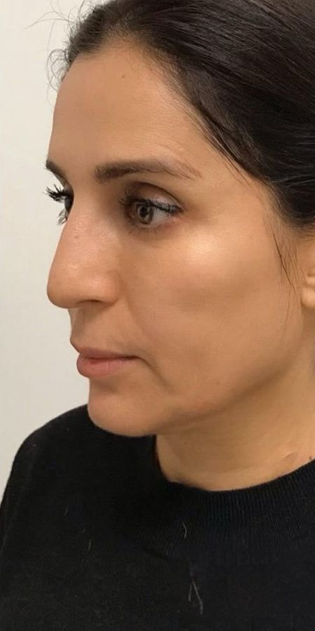 9 Dermal Filler in Milford, CT Before after images