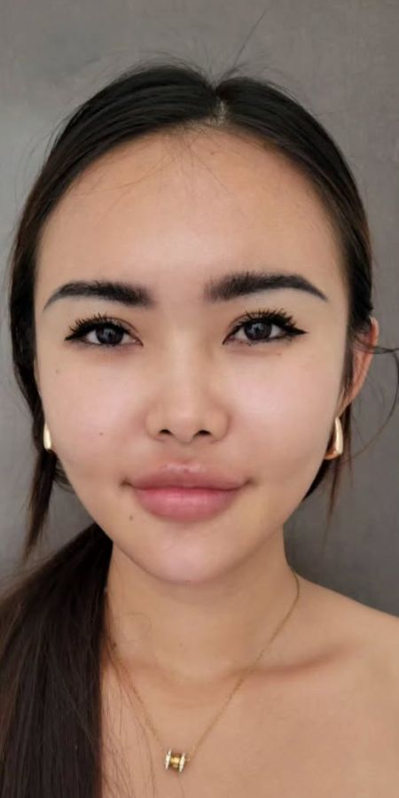 Dermal Filler in Milford, CT Before after images Dermal Filler in Milford, CT Before after images