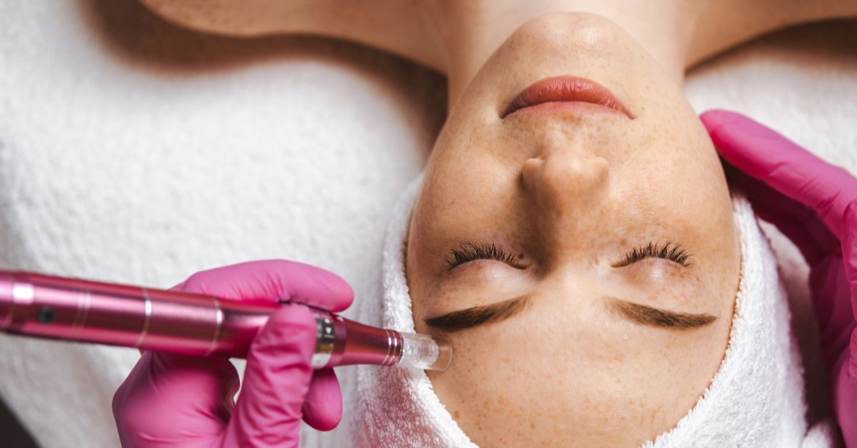 Microneedling Benefits