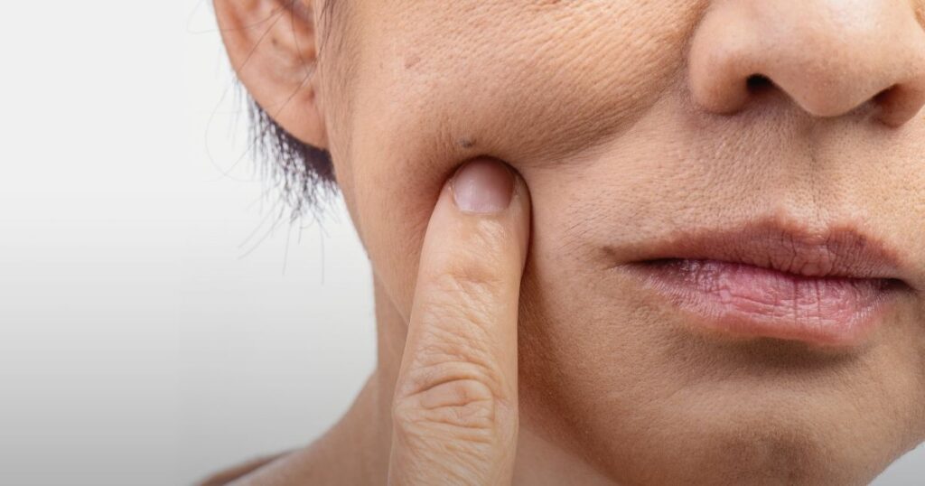 Fillers Are Only for Older People