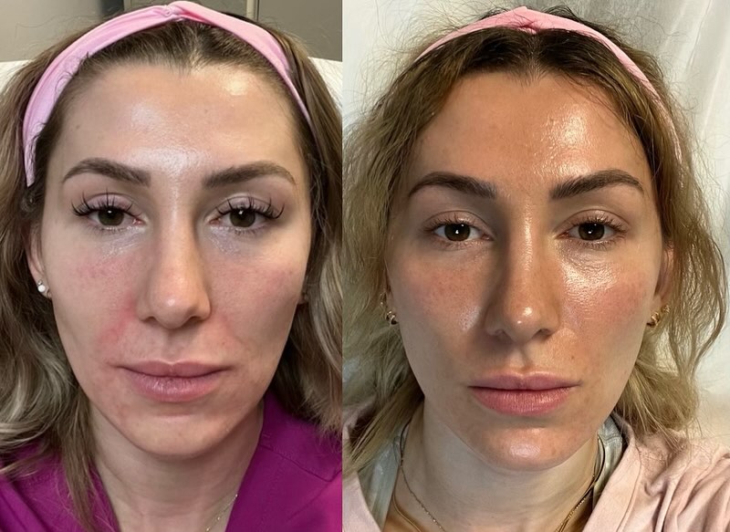 How Aquagold Facials Work