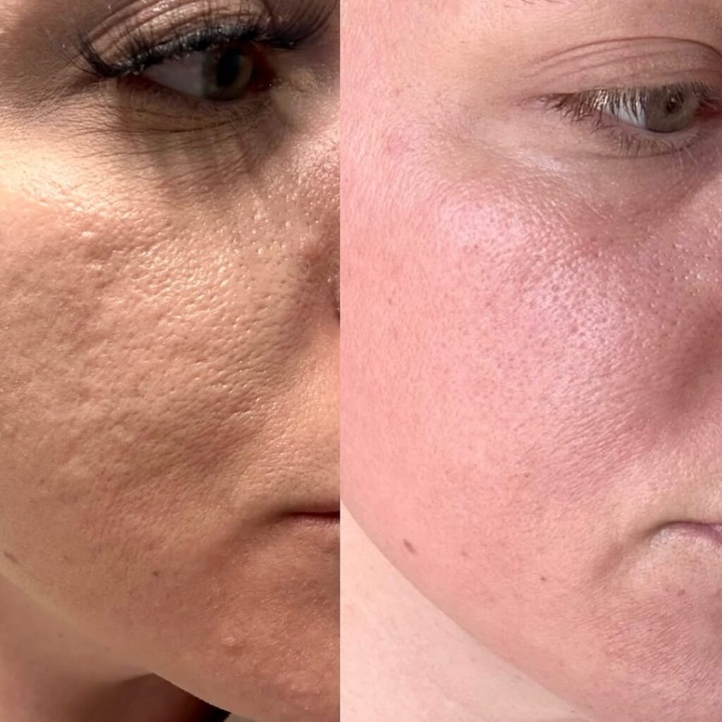 Microneedling Recovery Tips