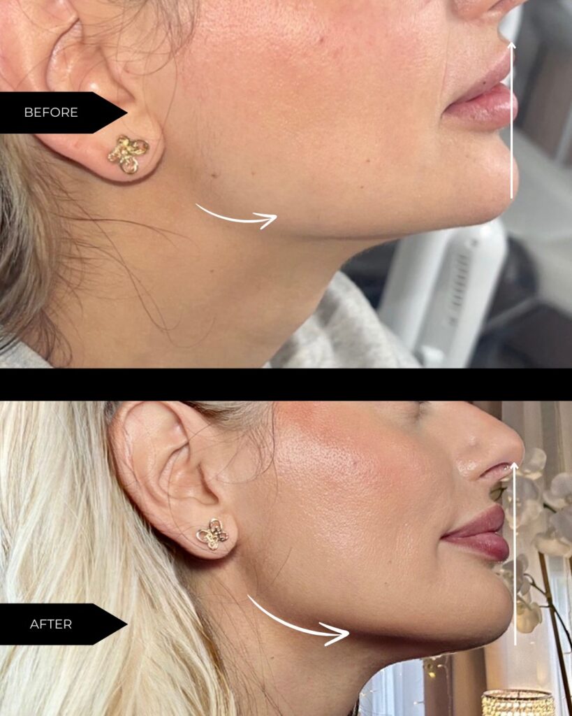 Dermal Fillers Recovery Tips