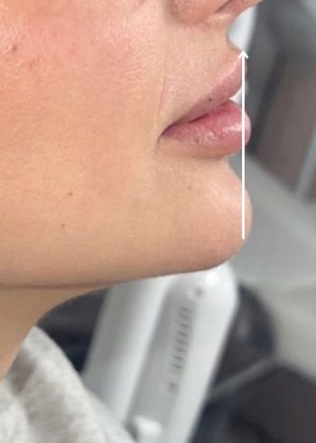 dermal fillers services in Milford ct after image (1)