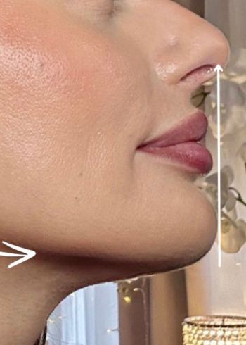 dermal fillers services in Milford ct before image