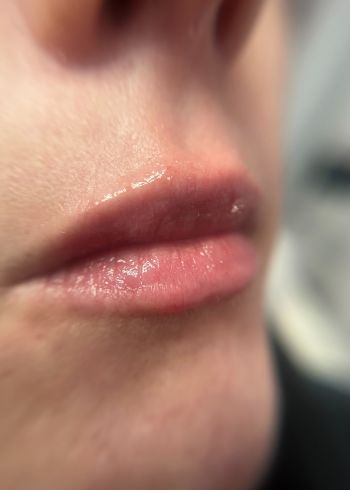dermal fillers services in Milford ct after image