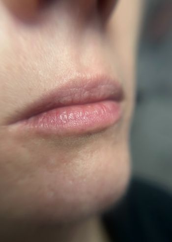 dermal fillers services in Milford ct before image