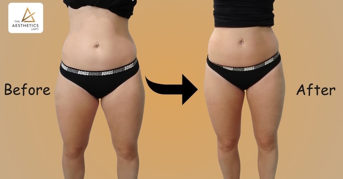 Understanding Non-Surgical Fat Melting Is It Right for You